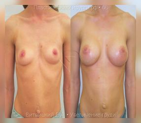 увеличение груди, результат №68, предварительное изображение до и после операции