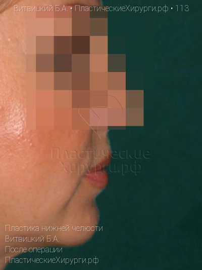 пластика нижней челюсти, пластический хирург Витвицкий Б. А., результат №113, ракурс 3, фото после операции