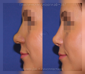 ринопластика, результат №397, предварительное изображение до и после операции
