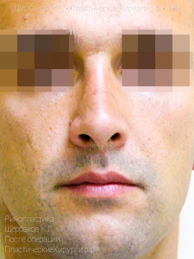 ринопластика, пластический хирург Щербаков К. Г., результат №490, ракурс 1, фото после операции