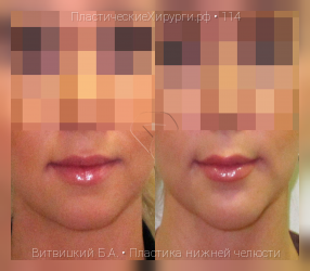 пластика нижней челюсти, результат №114, предварительное изображение до и после операции