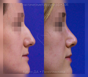 ринопластика, результат №398, предварительное изображение до и после операции