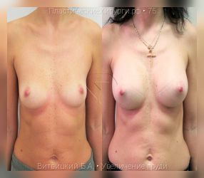 увеличение груди, результат №75, предварительное изображение до и после операции