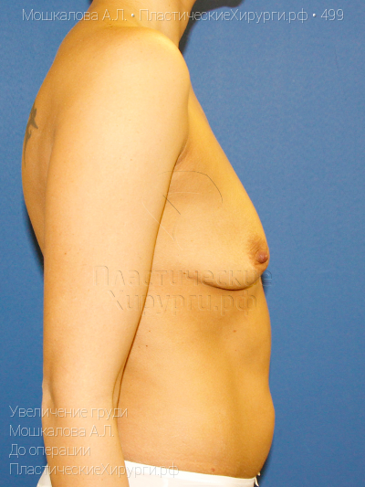 увеличение груди, пластический хирург Мошкалова А. Л., результат №499, ракурс 3, фото до операции