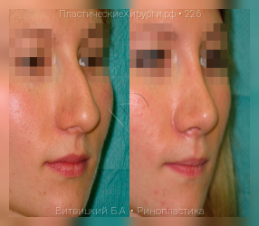 ринопластика, результат №226, предварительное изображение до и после операции