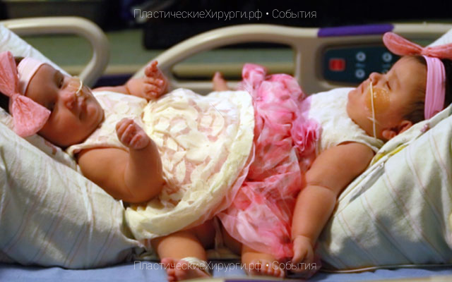 Операцию по разделению сиамских близнецов провели в США