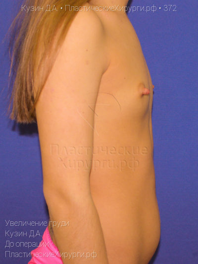 увеличение груди, пластический хирург Кузин Д. А., результат №372, ракурс 3, фото до операции