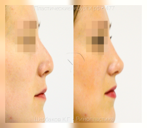 ринопластика, результат №477, предварительное изображение до и после операции
