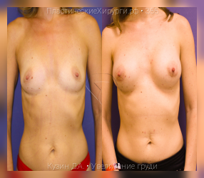 увеличение груди, результат №355, предварительное изображение до и после операции