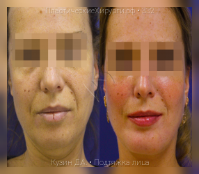 подтяжка лица, результат №332, предварительное изображение до и после операции
