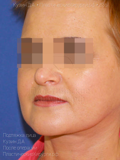 подтяжка лица, пластический хирург Кузин Д. А., результат №336, ракурс 2, фото после операции