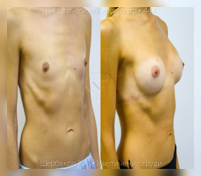 увеличение груди, результат №444, предварительное изображение до и после операции