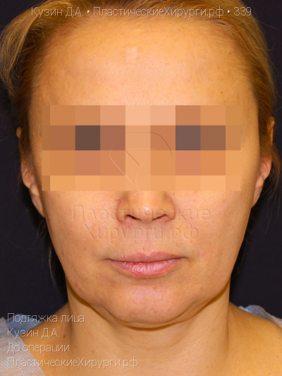 подтяжка лица, пластический хирург Кузин Д. А., результат №339, ракурс 1, фото до операции