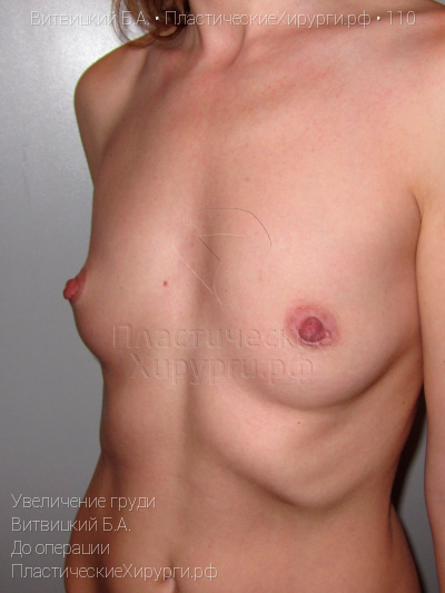 увеличение груди, пластический хирург Витвицкий Б. А., результат №110, ракурс 4, фото до операции