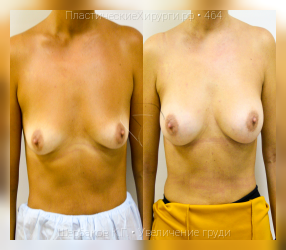 увеличение груди, результат №464, предварительное изображение до и после операции