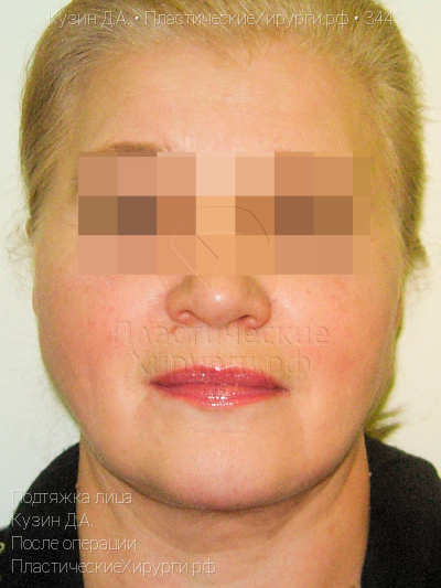 подтяжка лица, пластический хирург Кузин Д. А., результат №344, ракурс 1, фото после операции
