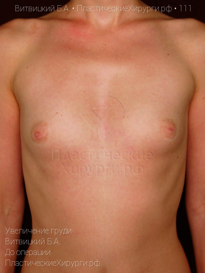 увеличение груди, пластический хирург Витвицкий Б. А., результат №111, ракурс 1, фото до операции