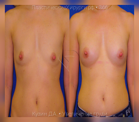увеличение груди, результат №366, предварительное изображение до и после операции