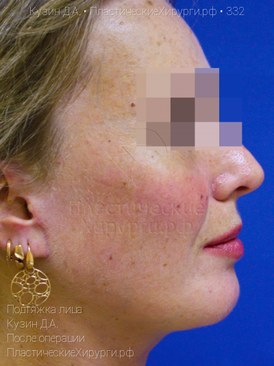 подтяжка лица, пластический хирург Кузин Д. А., результат №332, ракурс 3, фото после операции