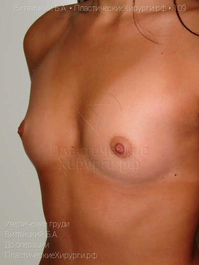 увеличение груди, пластический хирург Витвицкий Б. А., результат №109, ракурс 3, фото до операции