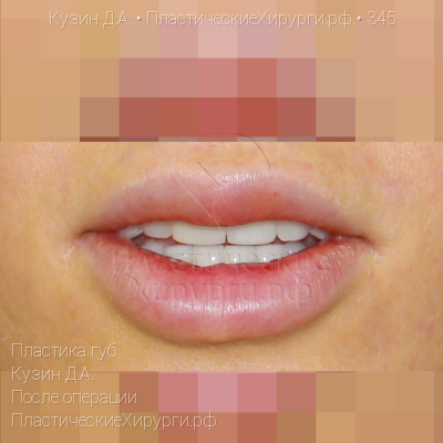 пластика губ, пластический хирург Кузин Д. А., результат №345, ракурс 1, фото после операции