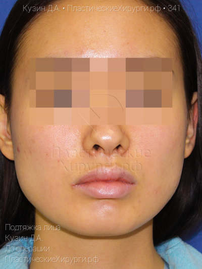 подтяжка лица, пластический хирург Кузин Д. А., результат №341, ракурс 1, фото до операции