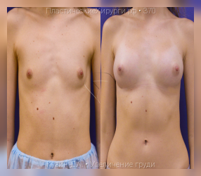 увеличение груди, результат №370, предварительное изображение до и после операции