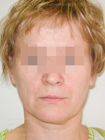 подтяжка лица, пластический хирург Кузин Д. А., результат №343, ракурс 1, фото до операции