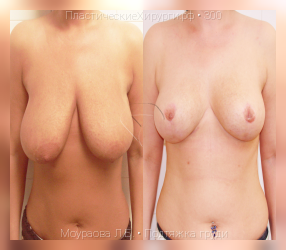подтяжка груди, результат №300, предварительное изображение до и после операции