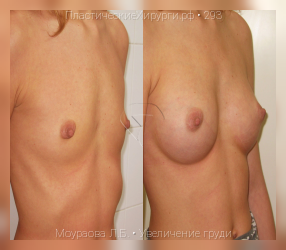 увеличение груди, результат №293, предварительное изображение до и после операции