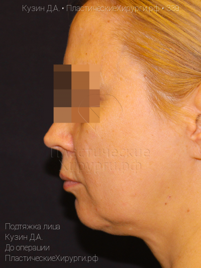 подтяжка лица, пластический хирург Кузин Д. А., результат №339, ракурс 3, фото до операции