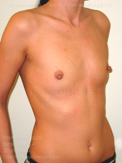 увеличение груди, пластический хирург Витвицкий Б. А., результат №37, ракурс 2, фото до операции