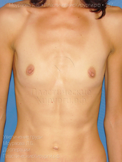 увеличение груди, пластический хирург Моураова Л. Б., результат №287, ракурс 1, фото до операции
