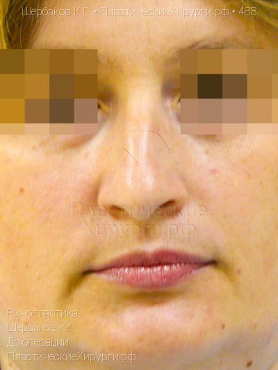 ринопластика, пластический хирург Щербаков К. Г., результат №488, ракурс 1, фото до операции