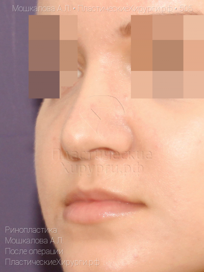 ринопластика, пластический хирург Мошкалова А. Л., результат №505, ракурс 4, фото после операции