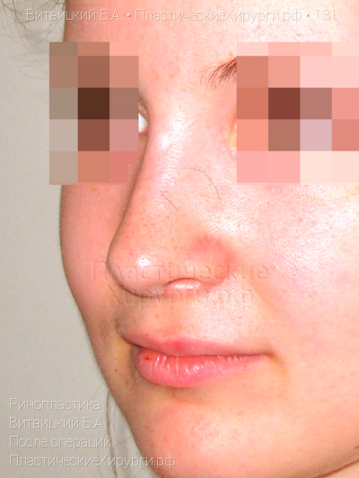 ринопластика, пластический хирург Витвицкий Б. А., результат №131, ракурс 3, фото после операции