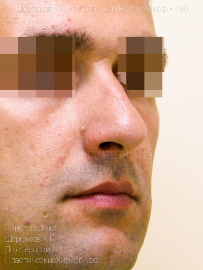 ринопластика, пластический хирург Щербаков К. Г., результат №490, ракурс 2, фото до операции
