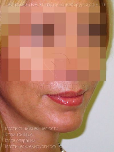 пластика нижней челюсти, пластический хирург Витвицкий Б. А., результат №115, ракурс 2, фото после операции