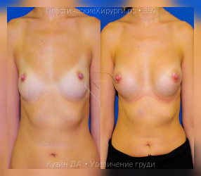увеличение груди, результат №359, предварительное изображение до и после операции