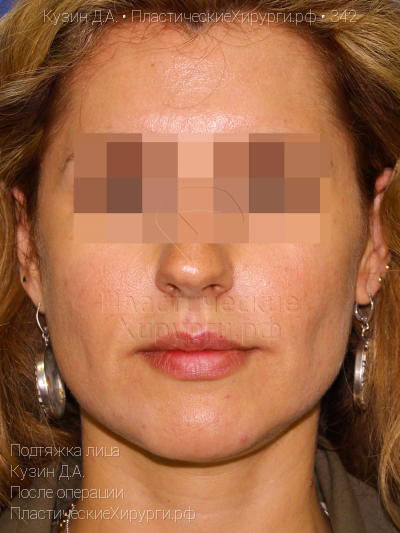 подтяжка лица, пластический хирург Кузин Д. А., результат №342, ракурс 1, фото после операции