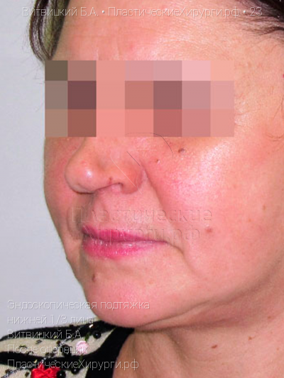 эндоскопическая подтяжка нижней трети лица, пластический хирург Витвицкий Б. А., результат №23, ракурс 2, фото после операции
