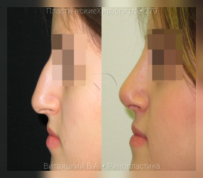ринопластика, результат №279, предварительное изображение до и после операции
