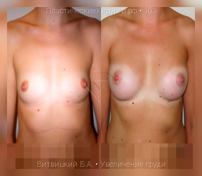 увеличение груди, результат №103, предварительное изображение до и после операции
