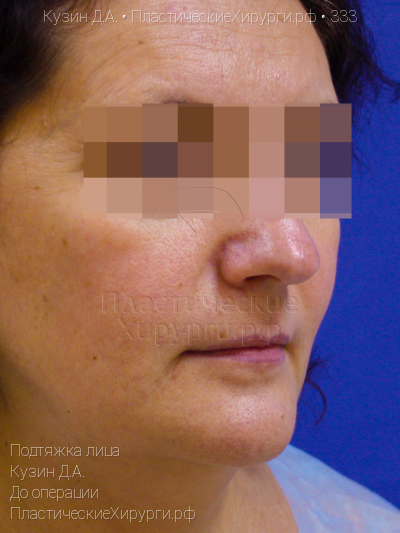 подтяжка лица, пластический хирург Кузин Д. А., результат №333, ракурс 2, фото до операции