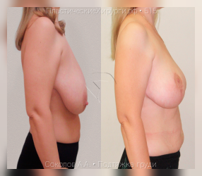 подтяжка груди, результат №515, предварительное изображение до и после операции