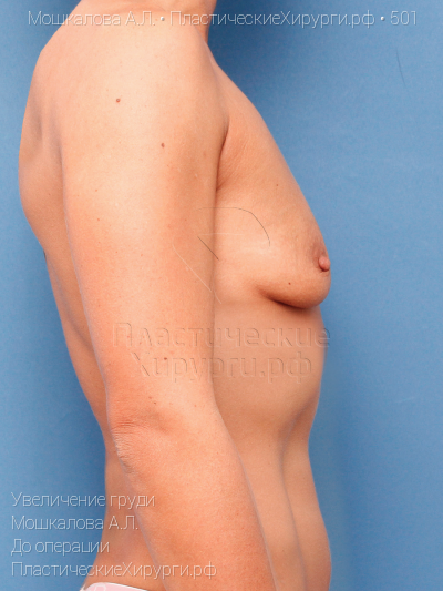увеличение груди, пластический хирург Мошкалова А. Л., результат №501, ракурс 3, фото до операции