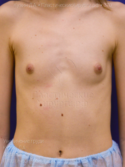 увеличение груди, пластический хирург Кузин Д. А., результат №370, ракурс 1, фото до операции