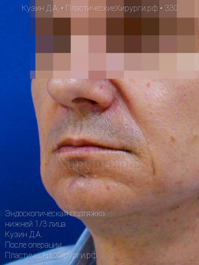 эндоскопическая подтяжка нижней трети лица, пластический хирург Кузин Д. А., результат №330, ракурс 2, фото после операции