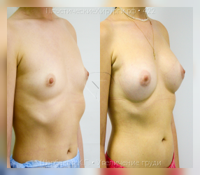 увеличение груди, результат №422, предварительное изображение до и после операции