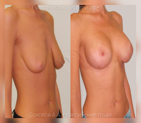 увеличение груди, результат №513, предварительное изображение до и после операции